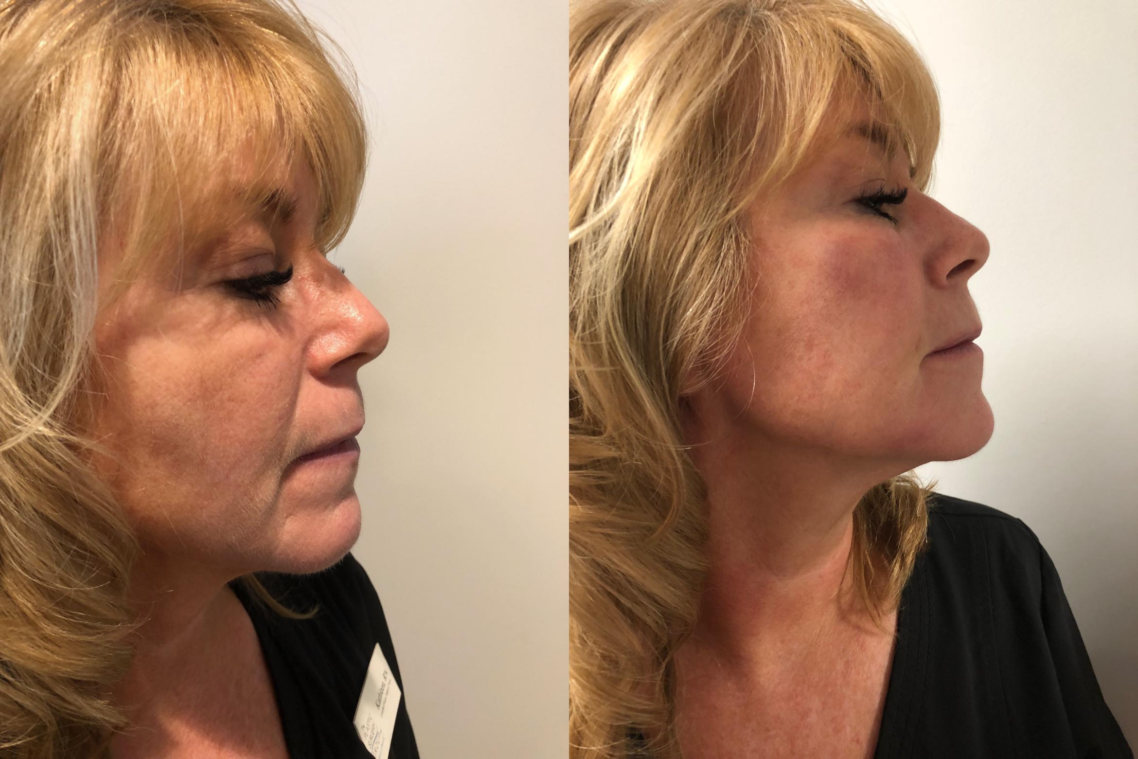 Before & After Injectable Fillers Case 296 View #1 View in Albany & Latham, New York