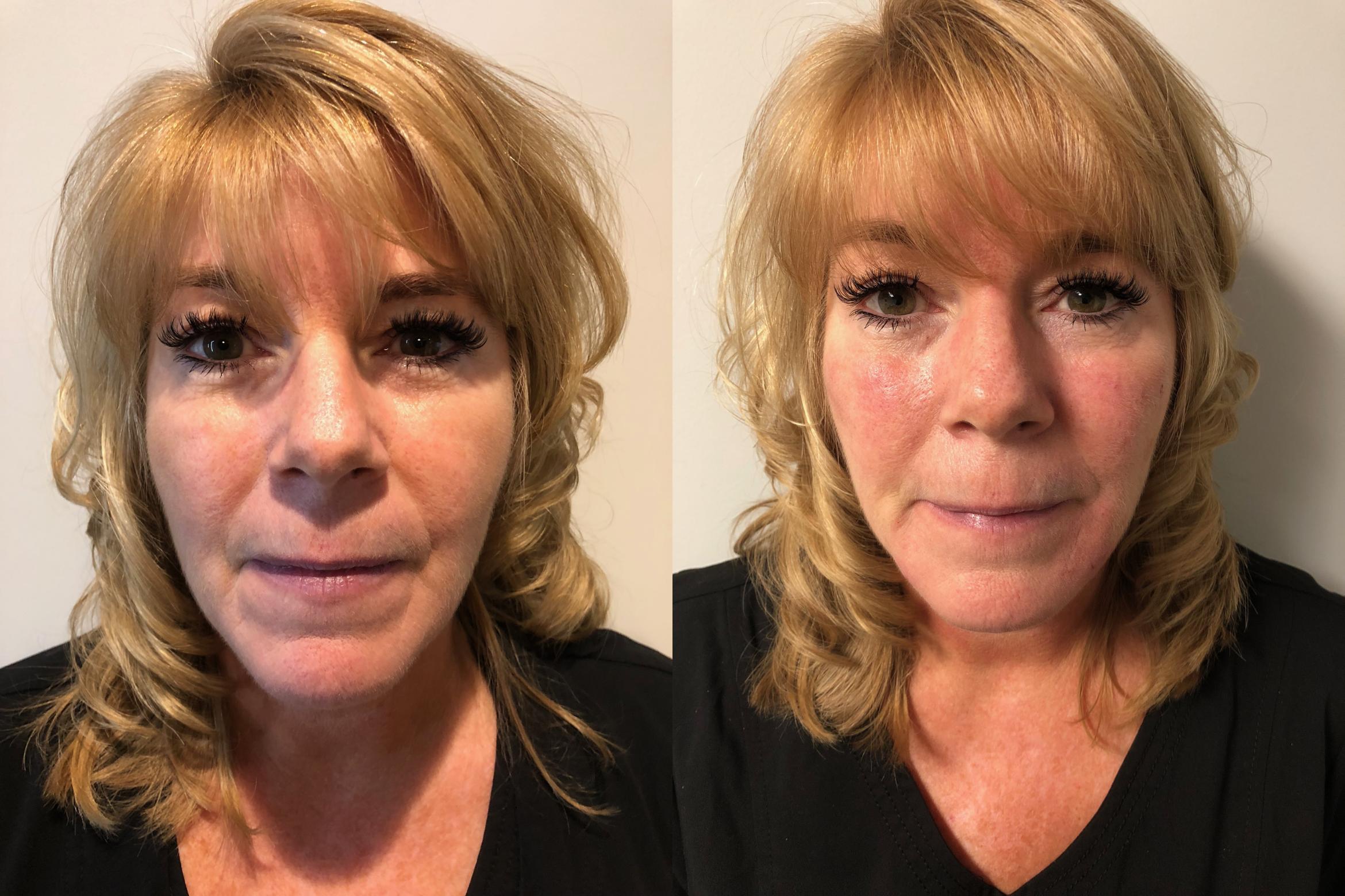 Before & After Injectable Fillers Case 296 View #2 View in Albany & Latham, New York