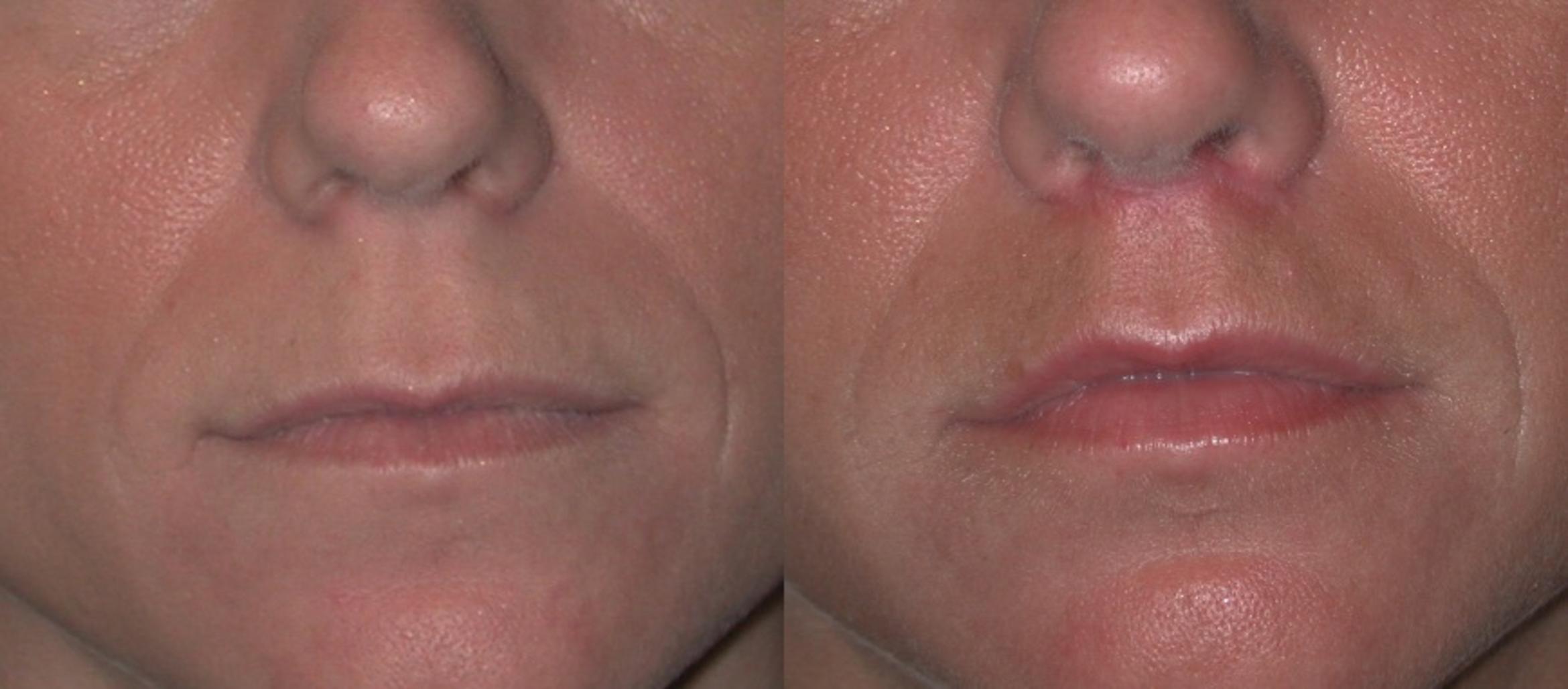Before & After Injectable Fillers Case 301 View #1 View in Albany & Latham, New York