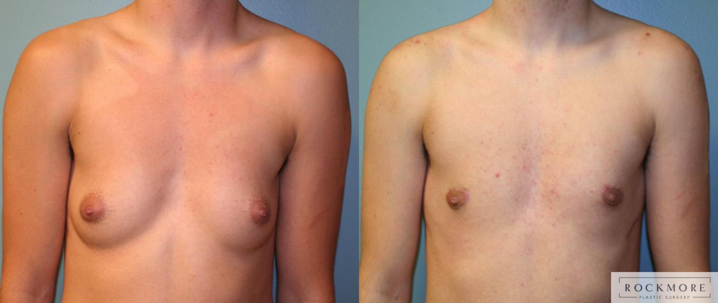 Before & After Gender Transformation FTM Case 165 View #1 View in Albany & Latham, New York