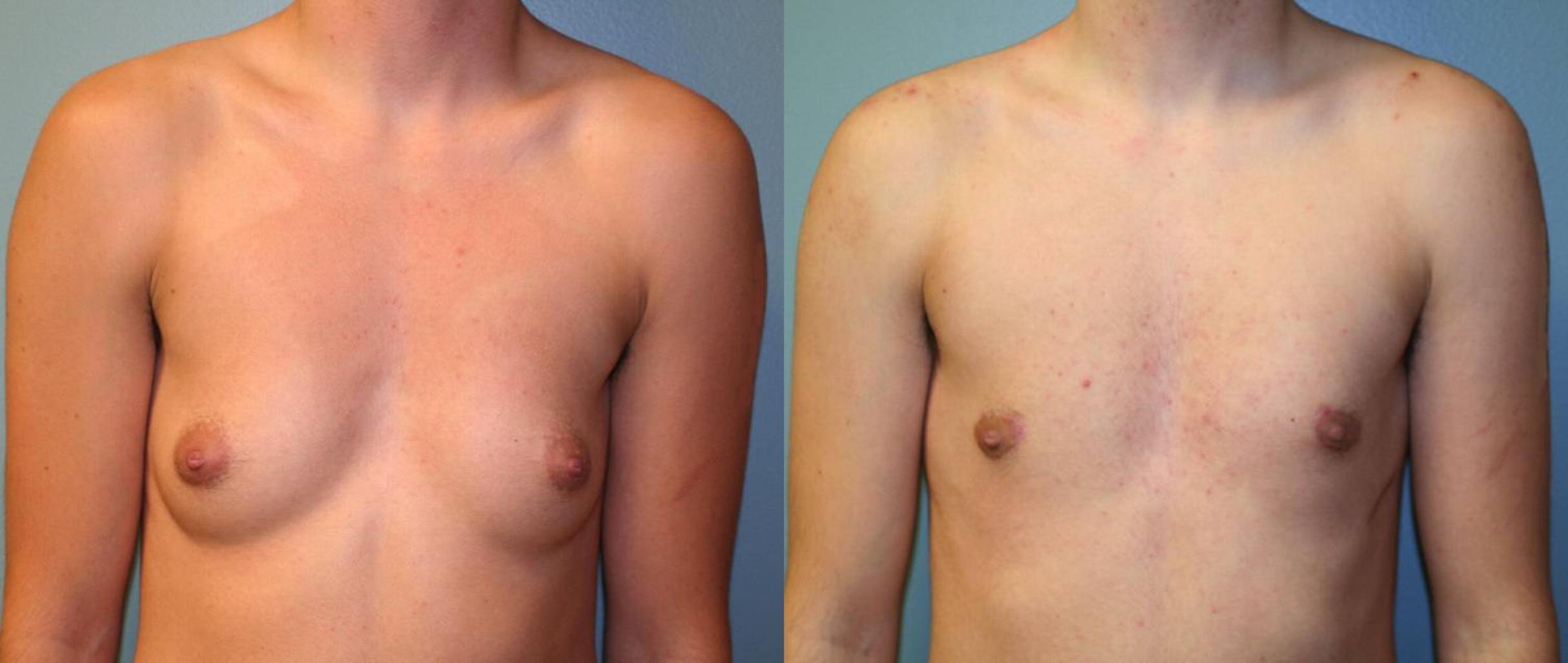 Before & After Gender Transformation FTM Case 165 View #1 View in Albany & Latham, New York