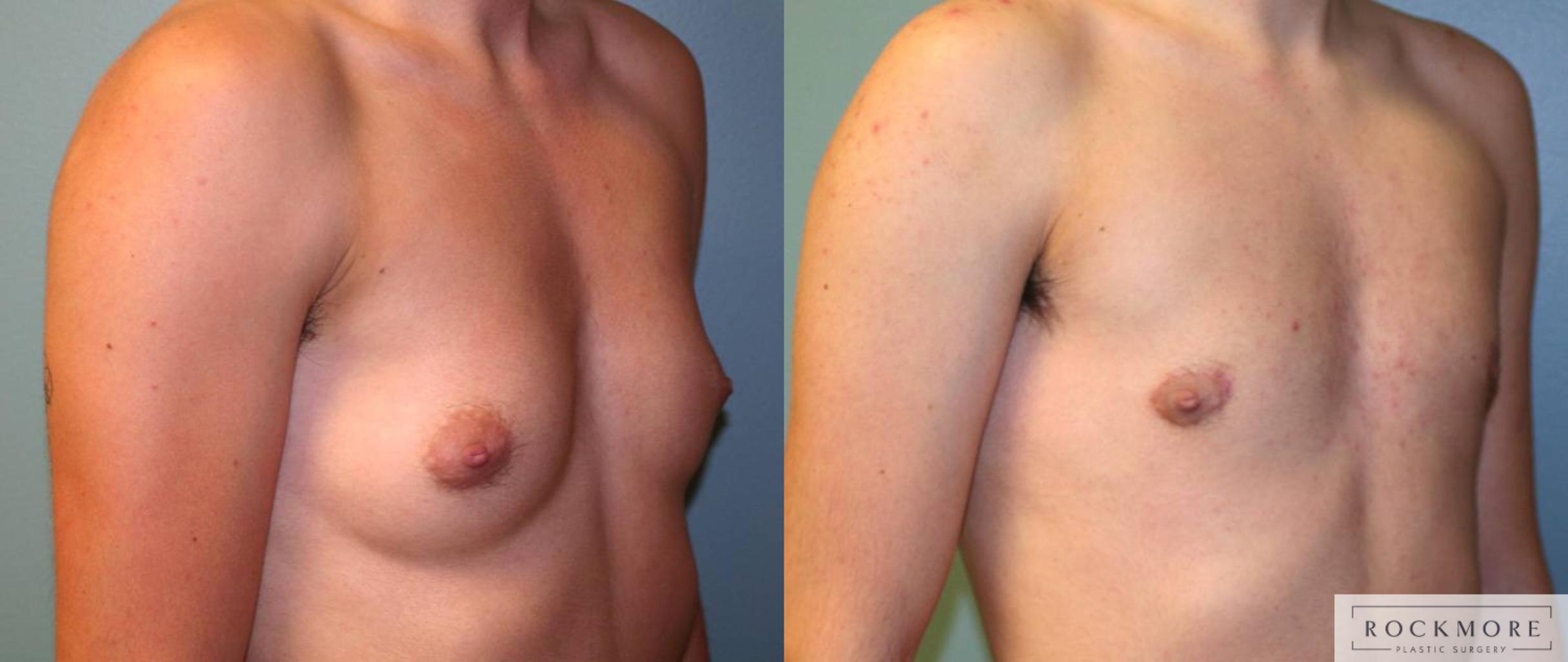 Before & After Gender Transformation FTM Case 165 View #2 View in Albany & Latham, New York