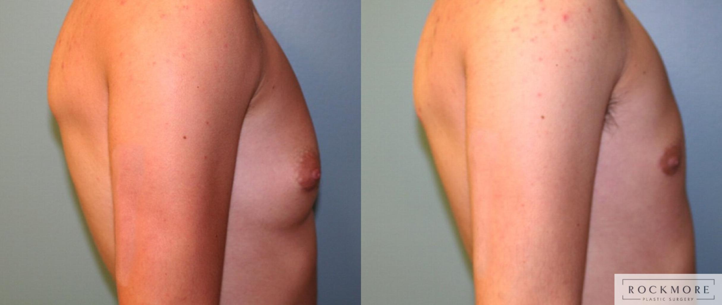 Before & After Gender Transformation FTM Case 165 View #3 View in Albany & Latham, New York