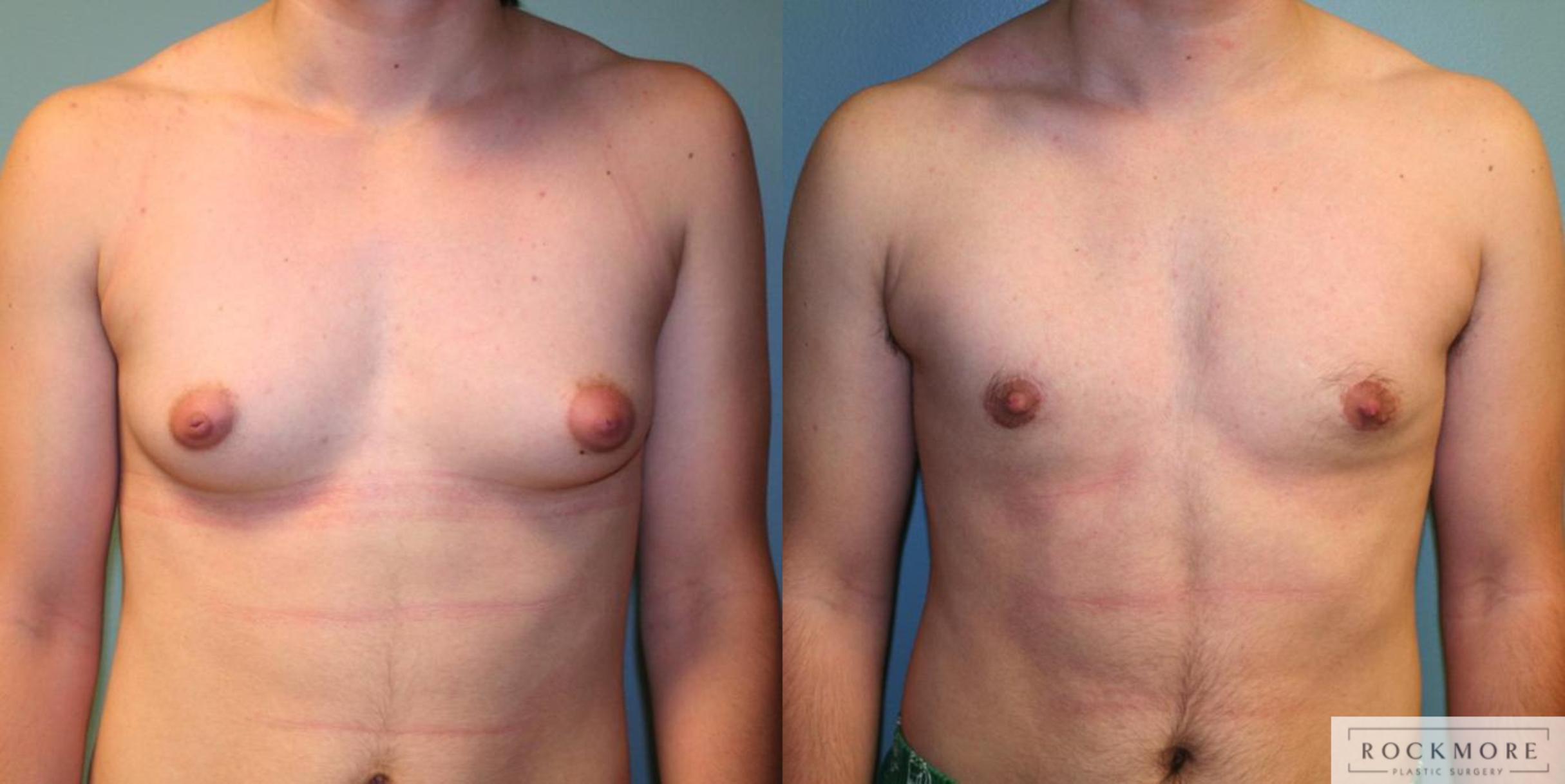 Before & After Gender Transformation FTM Case 166 View #1 View in Albany & Latham, New York