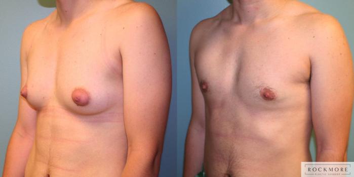Before & After Gender Transformation FTM Case 166 View #3 View in Albany & Latham, New York