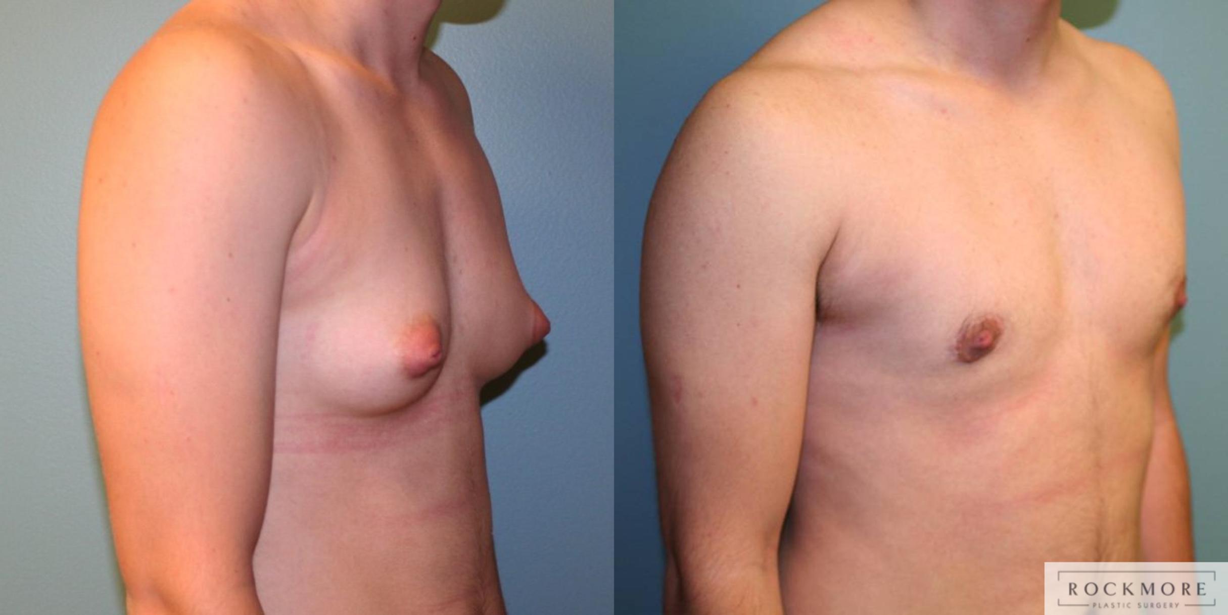 Before & After Gender Transformation FTM Case 166 View #4 View in Albany & Latham, New York