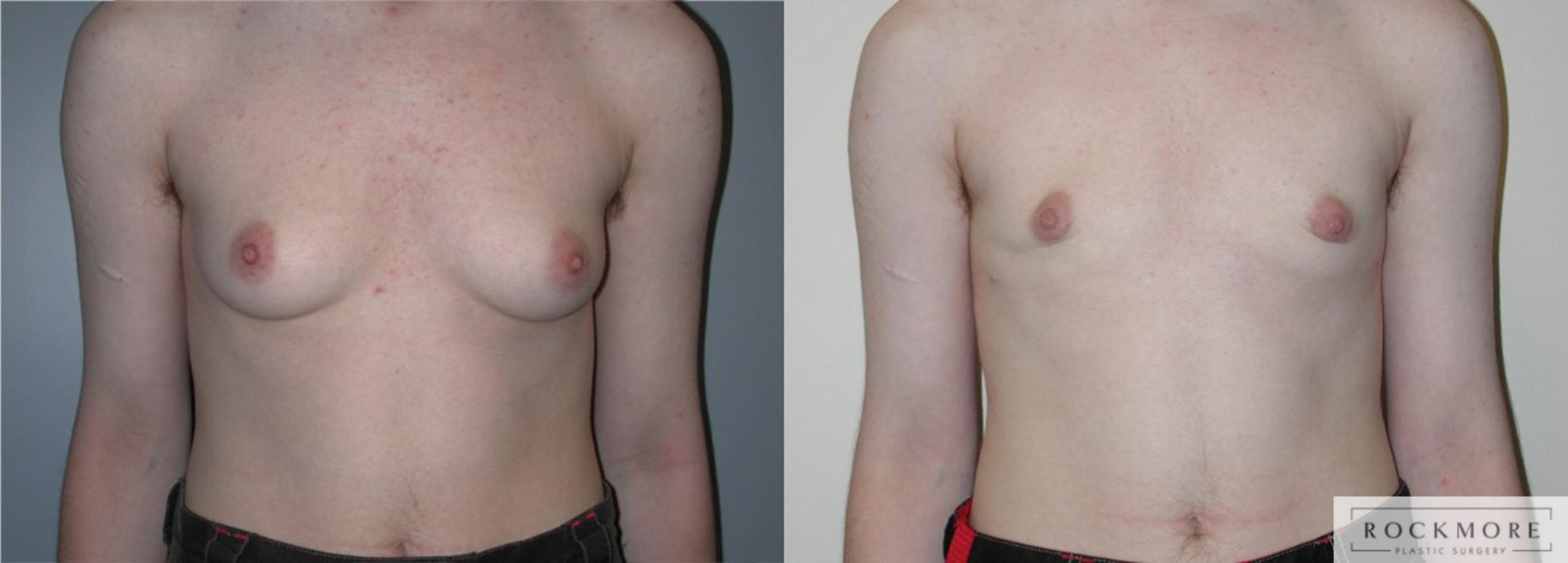 Before & After Gender Transformation FTM Case 178 View #1 View in Albany & Latham, New York