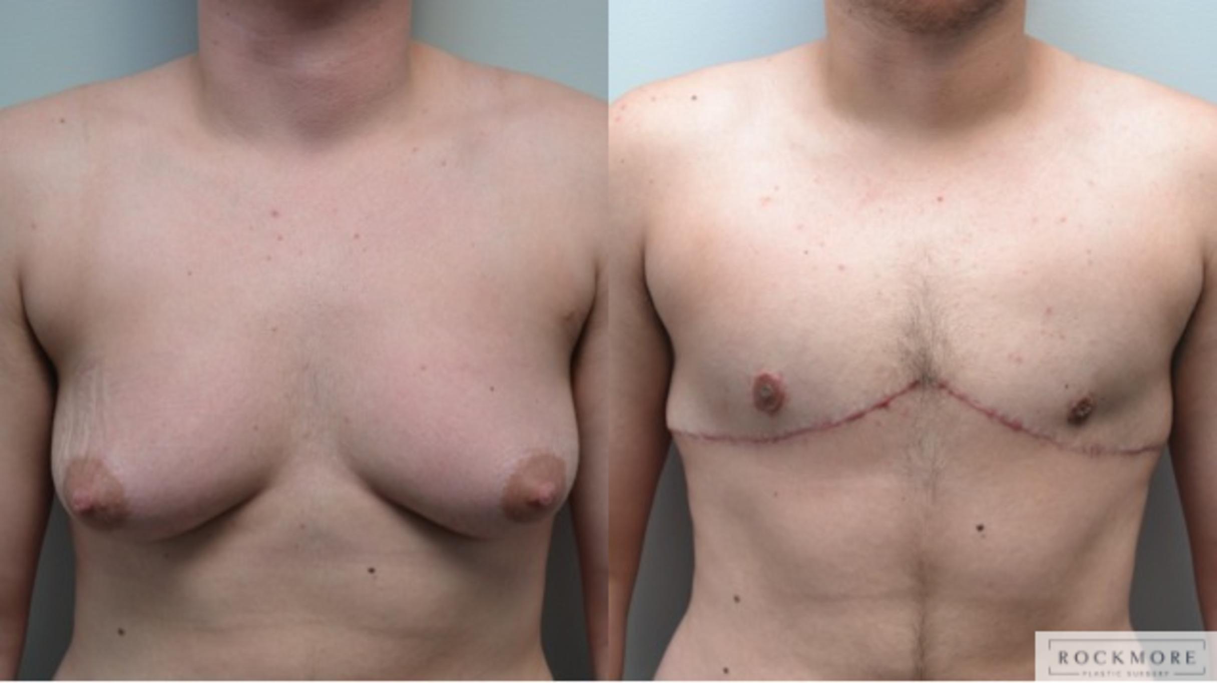 Before & After Gender Transformation FTM Case 210 View #1 View in Albany & Latham, New York