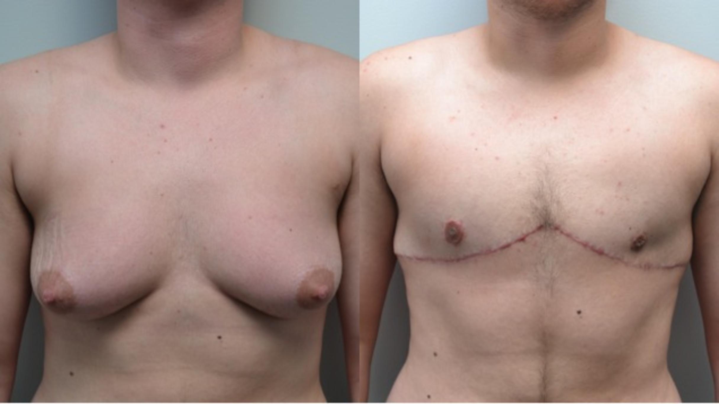 Before & After Gender Transformation FTM Case 210 View #1 View in Albany & Latham, New York