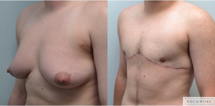 Before & After Gender Transformation FTM Case 210 View #2 View in Albany & Latham, New York
