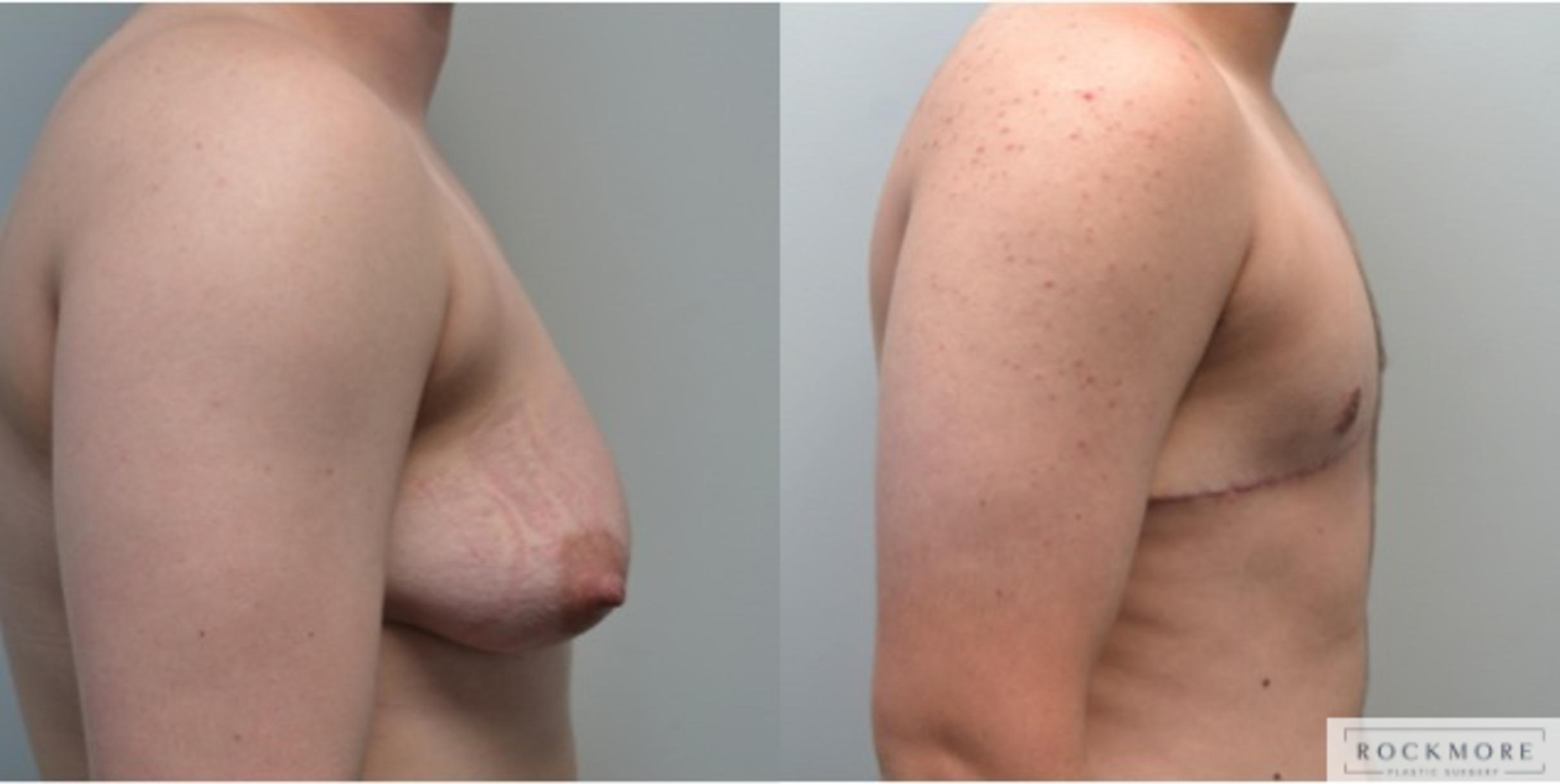 Before & After Gender Transformation FTM Case 210 View #3 View in Albany & Latham, New York