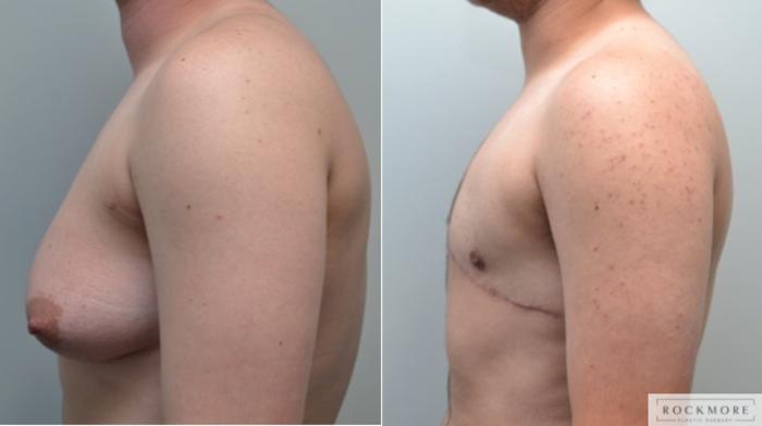 Before & After Gender Transformation FTM Case 210 View #4 View in Albany & Latham, New York