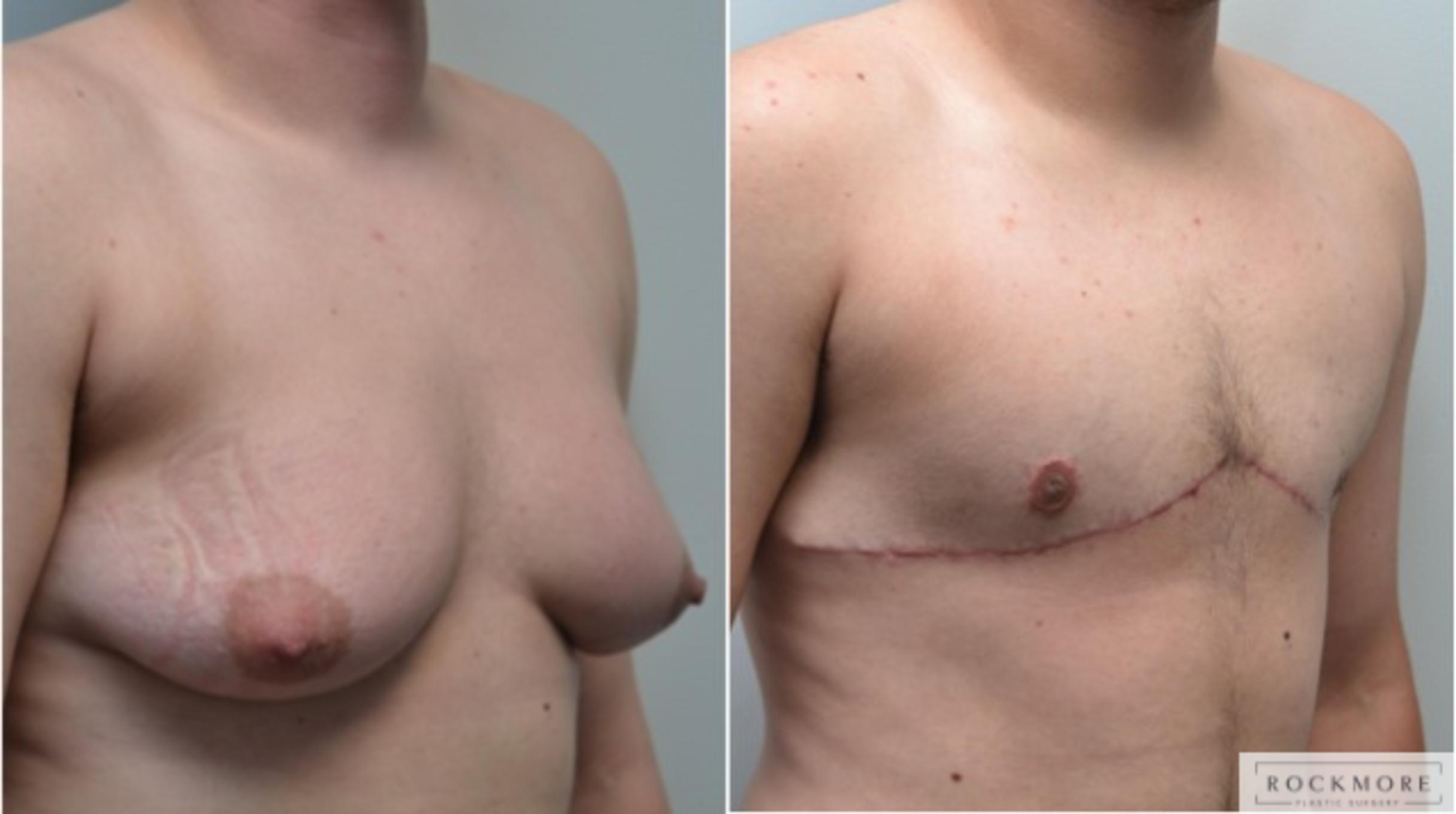 Before & After Gender Transformation FTM Case 210 View #5 View in Albany & Latham, New York