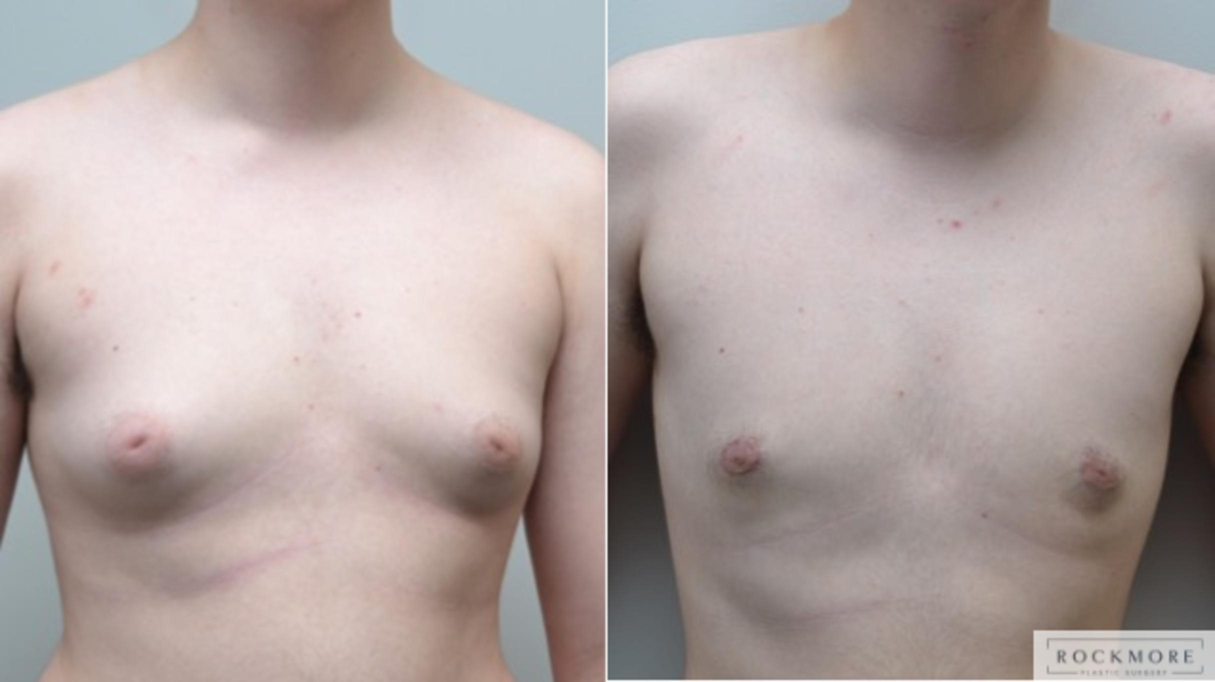 Before & After Gender Transformation FTM Case 268 View #1 View in Albany & Latham, New York