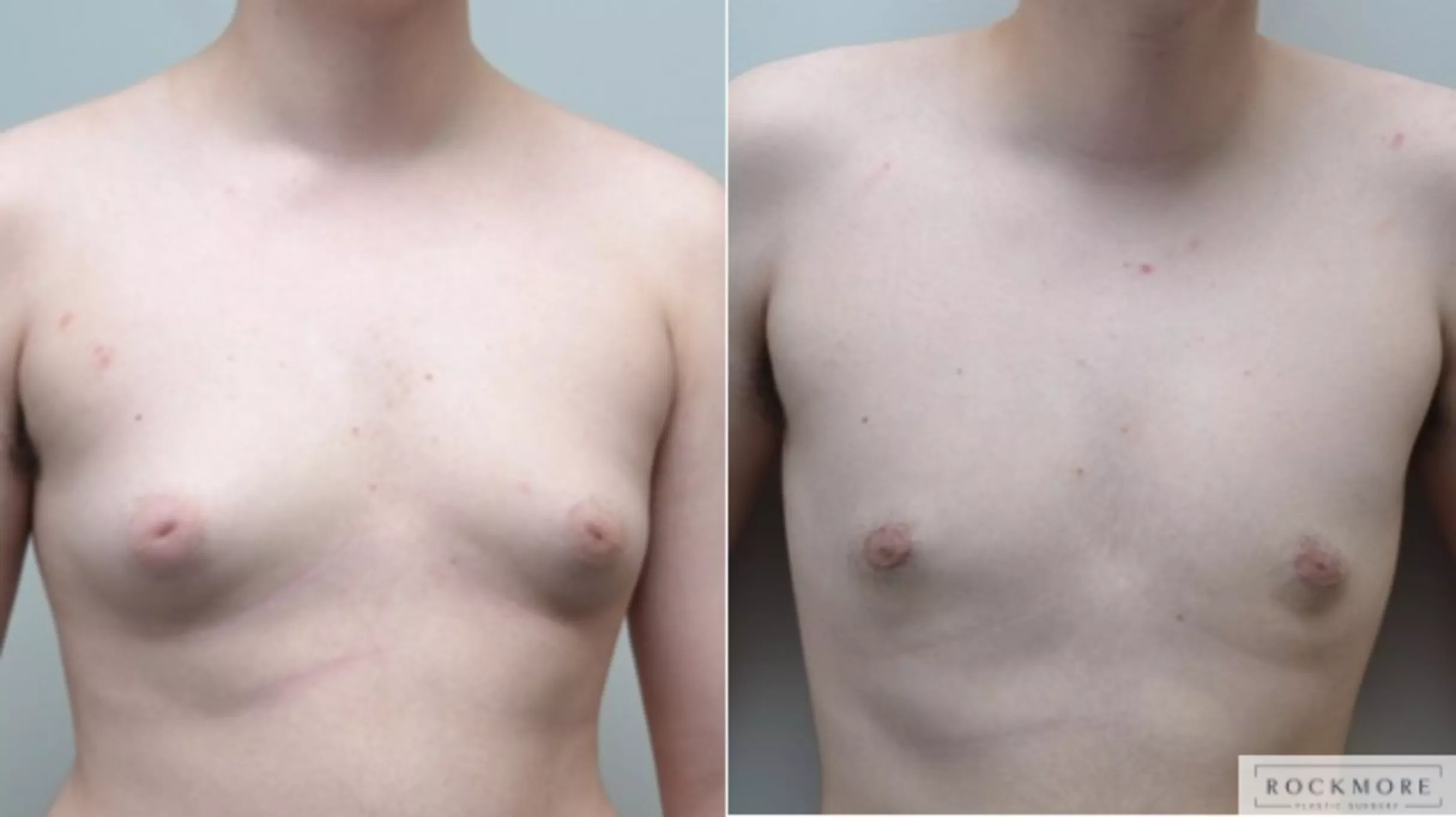 Gender Transformation FTM Before and After Pictures Case 268 | Albany &  Latham, New York | Rockmore Plastic Surgery