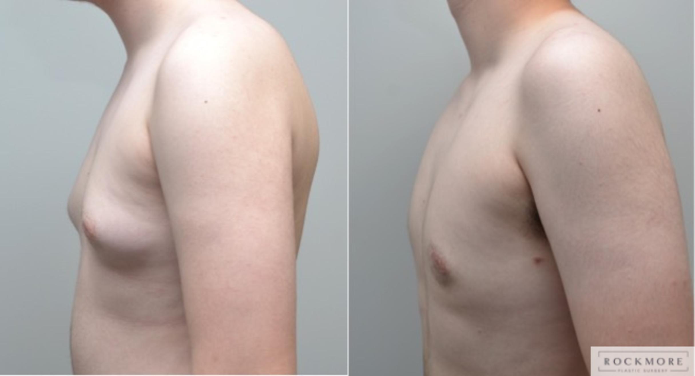 Before & After Gender Transformation FTM Case 268 View #2 View in Albany & Latham, New York