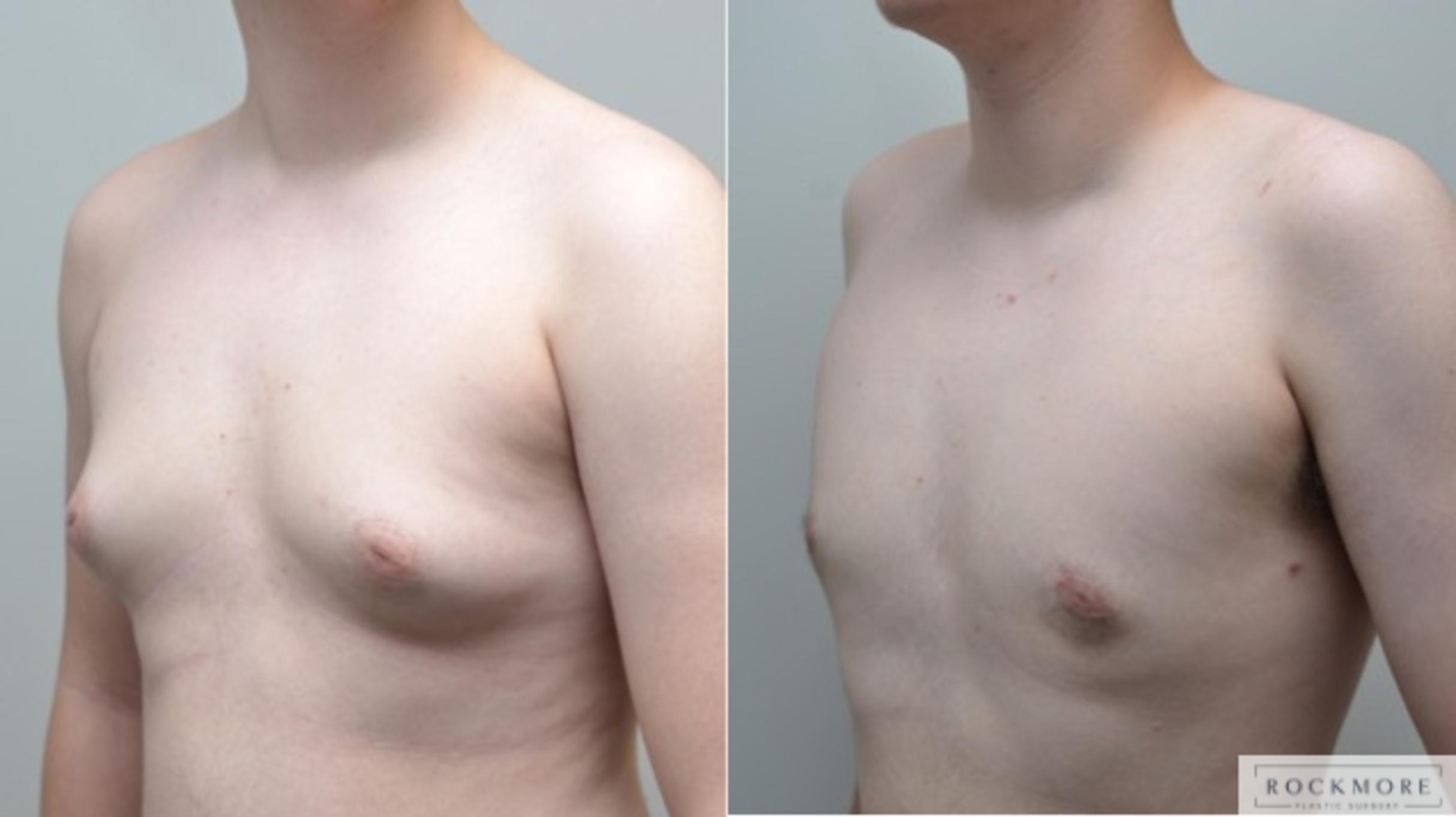 Before & After Gender Transformation FTM Case 268 View #3 View in Albany & Latham, New York