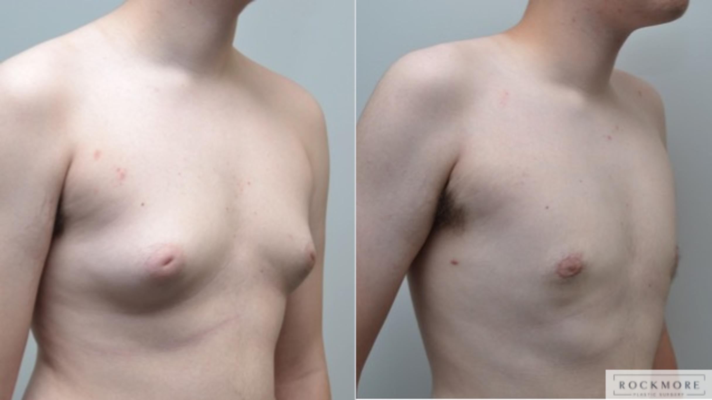 Before & After Gender Transformation FTM Case 268 View #4 View in Albany & Latham, New York