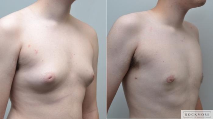 FTM Liposuction Transgender Body Contouring