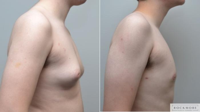 Before & After Gender Transformation FTM Case 268 View #5 View in Albany & Latham, New York