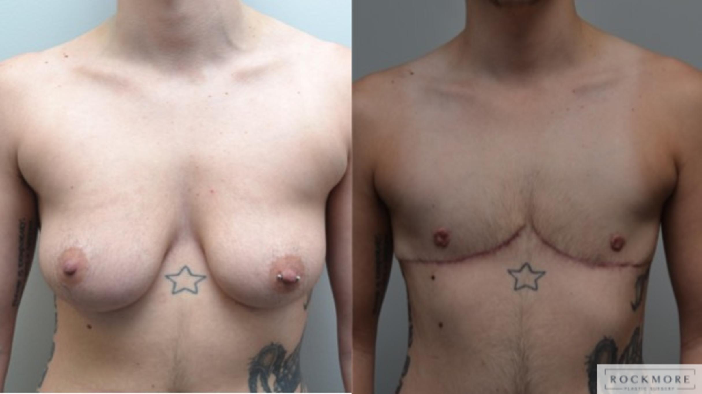 Before & After Gender Transformation FTM Case 269 View #1 View in Albany & Latham, New York