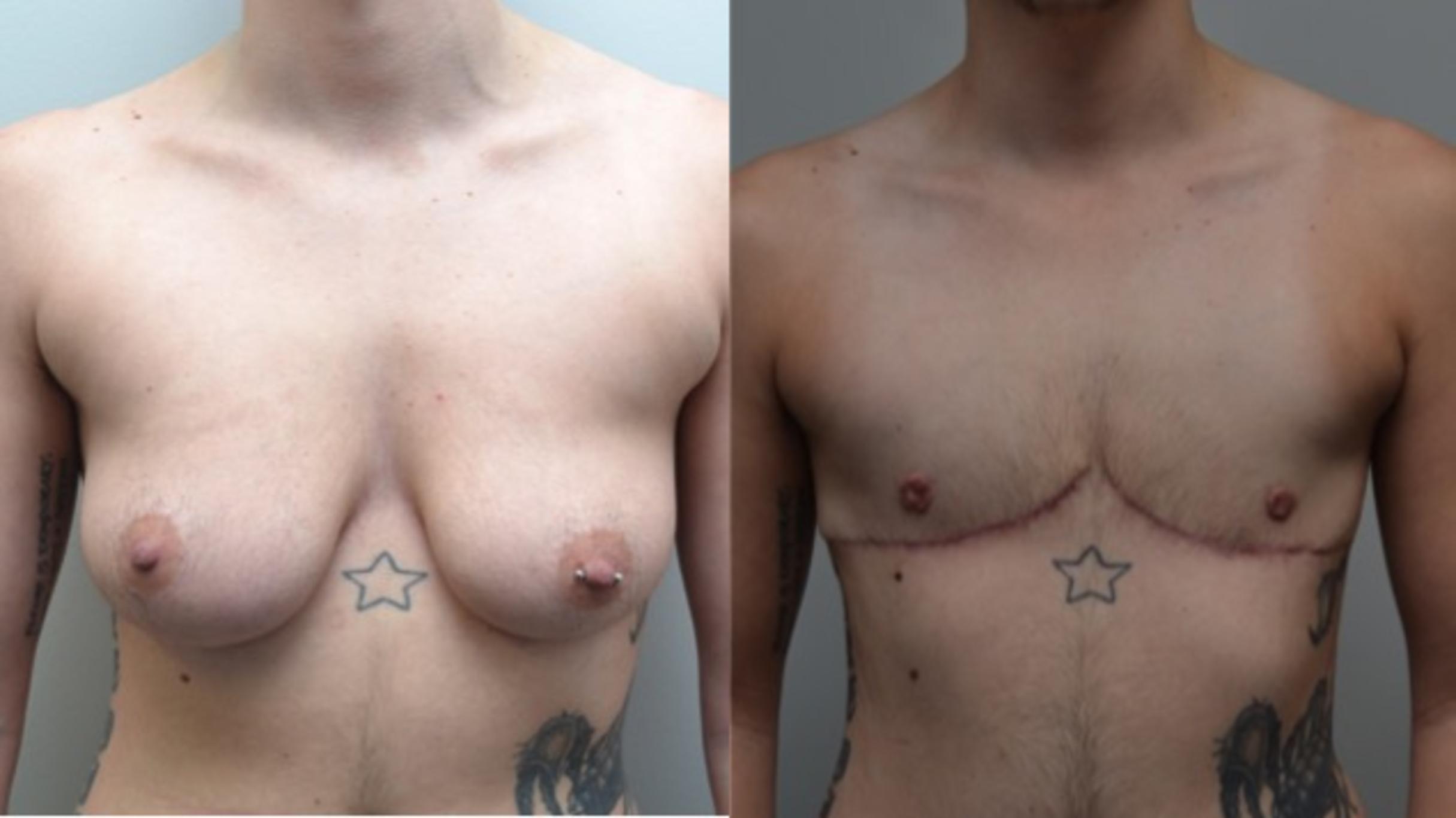 Before & After Gender Transformation FTM Case 269 View #1 View in Albany & Latham, New York