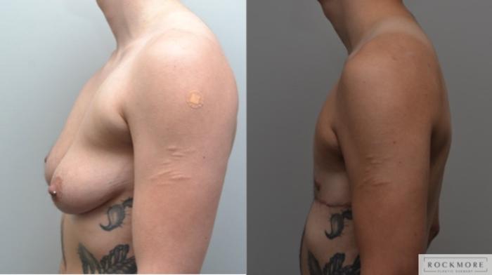 Before & After Gender Transformation FTM Case 269 View #2 View in Albany & Latham, New York