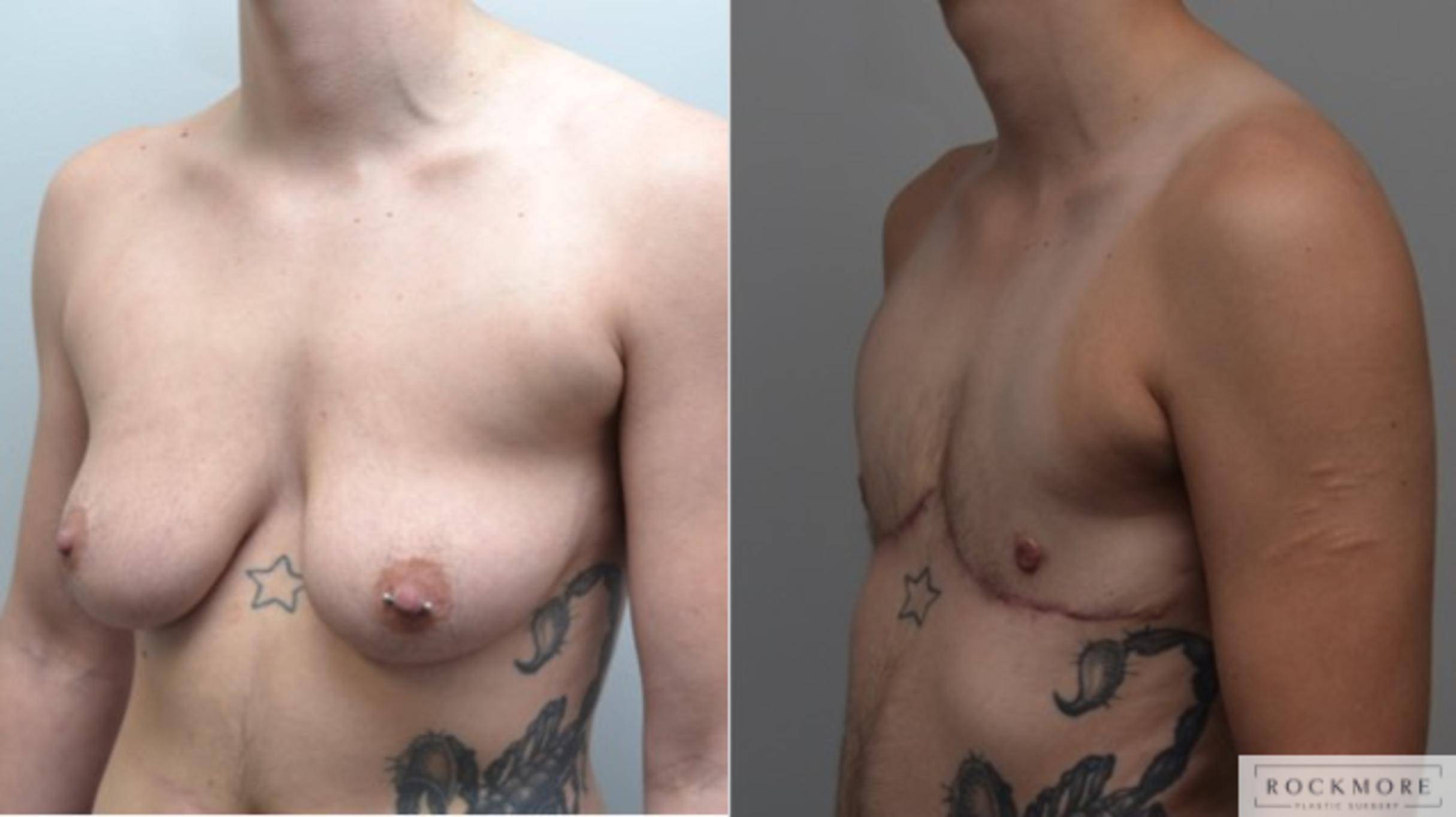 Before & After Gender Transformation FTM Case 269 View #3 View in Albany & Latham, New York