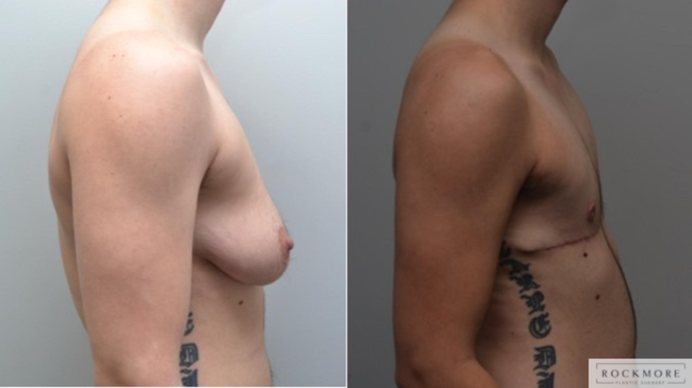 Before & After Gender Transformation FTM Case 269 View #4 View in Albany & Latham, New York