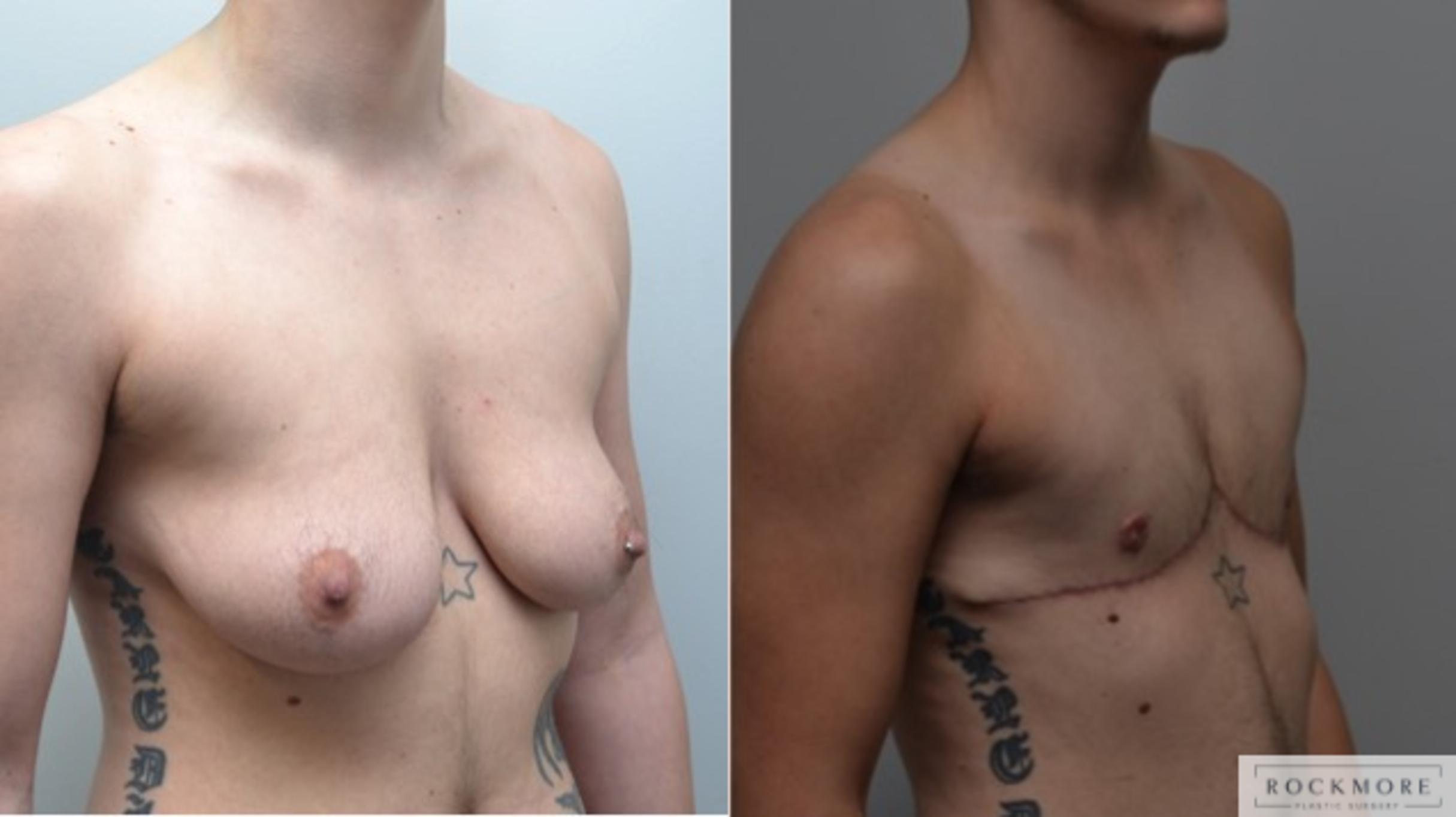Before & After Gender Transformation FTM Case 269 View #5 View in Albany & Latham, New York
