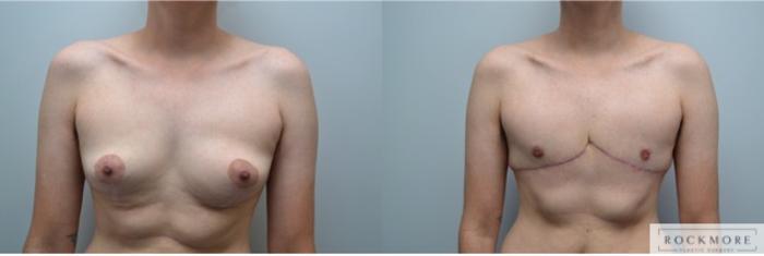 Before & After Gender Transformation FTM Case 270 View #1 View in Albany & Latham, New York