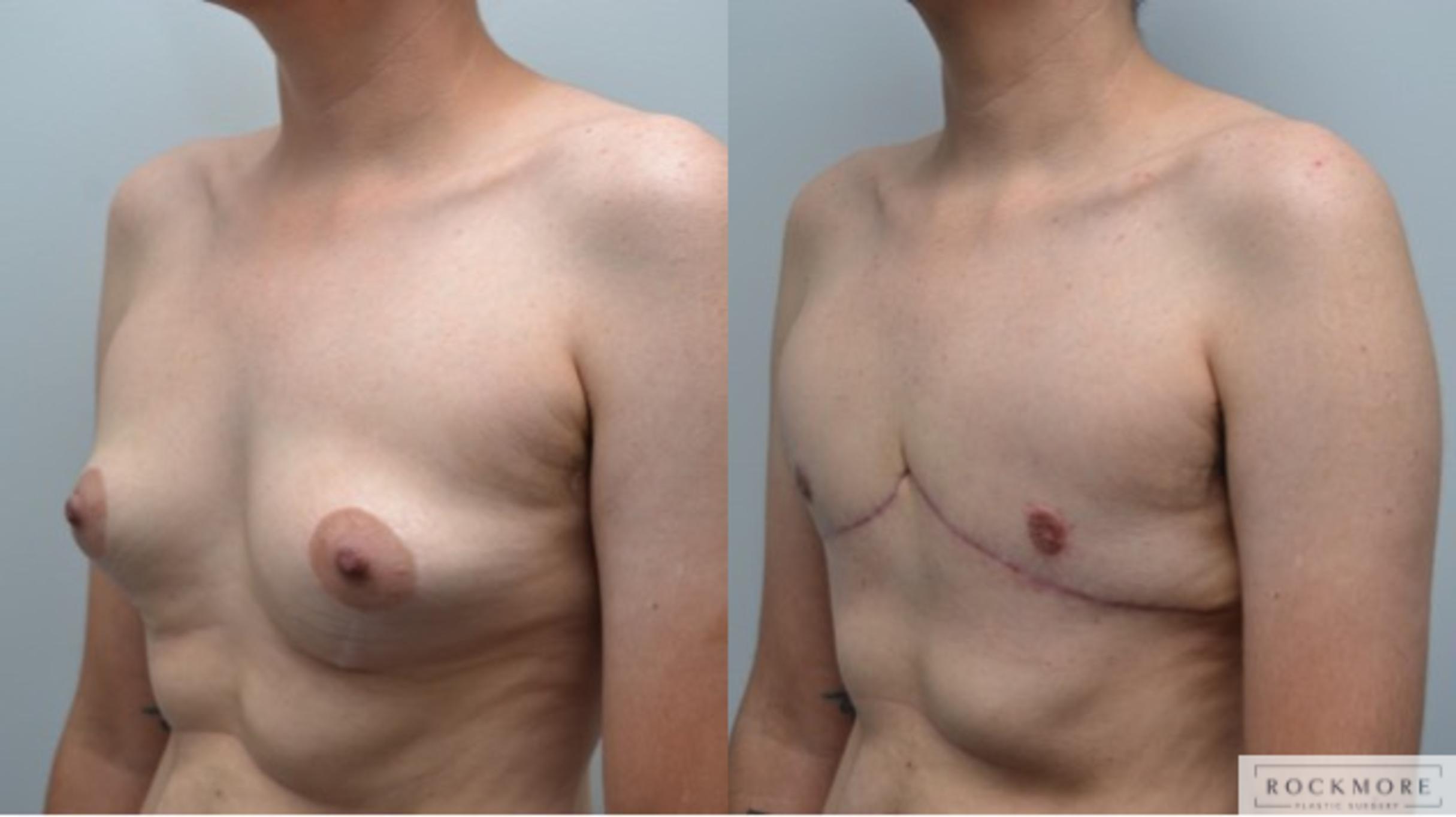 Before & After Gender Transformation FTM Case 270 View #3 View in Albany & Latham, New York
