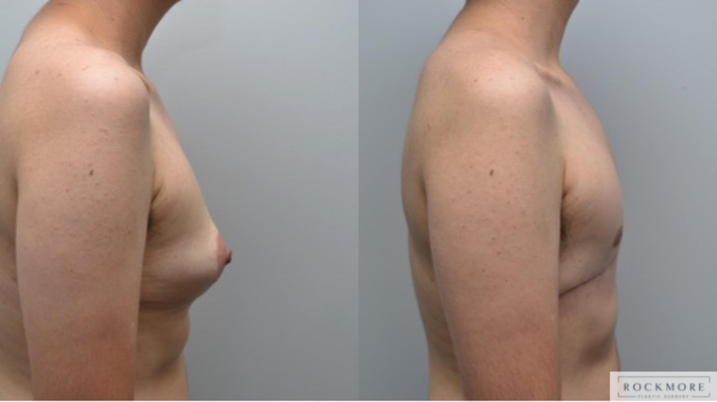 Before & After Gender Transformation FTM Case 270 View #4 View in Albany & Latham, New York