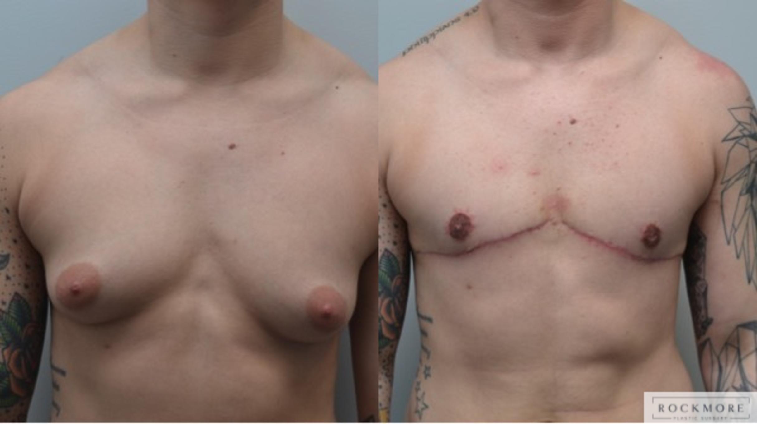 Before & After Gender Transformation FTM Case 286 View #1 View in Albany & Latham, New York