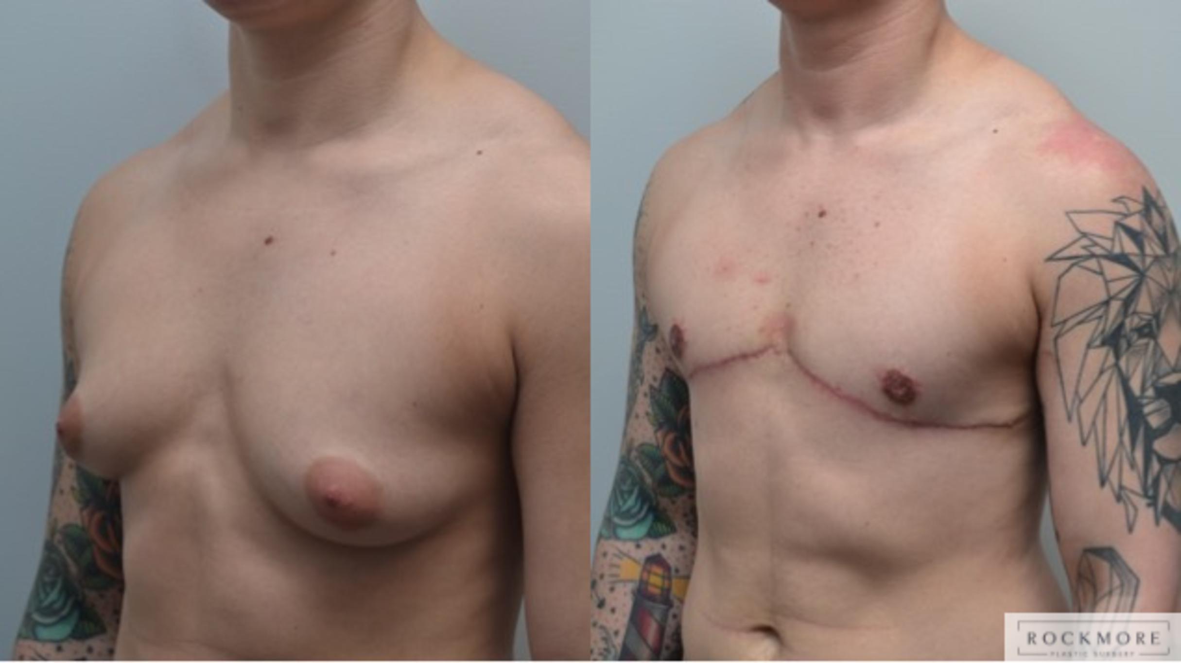 Before & After Gender Transformation FTM Case 286 View #3 View in Albany & Latham, New York