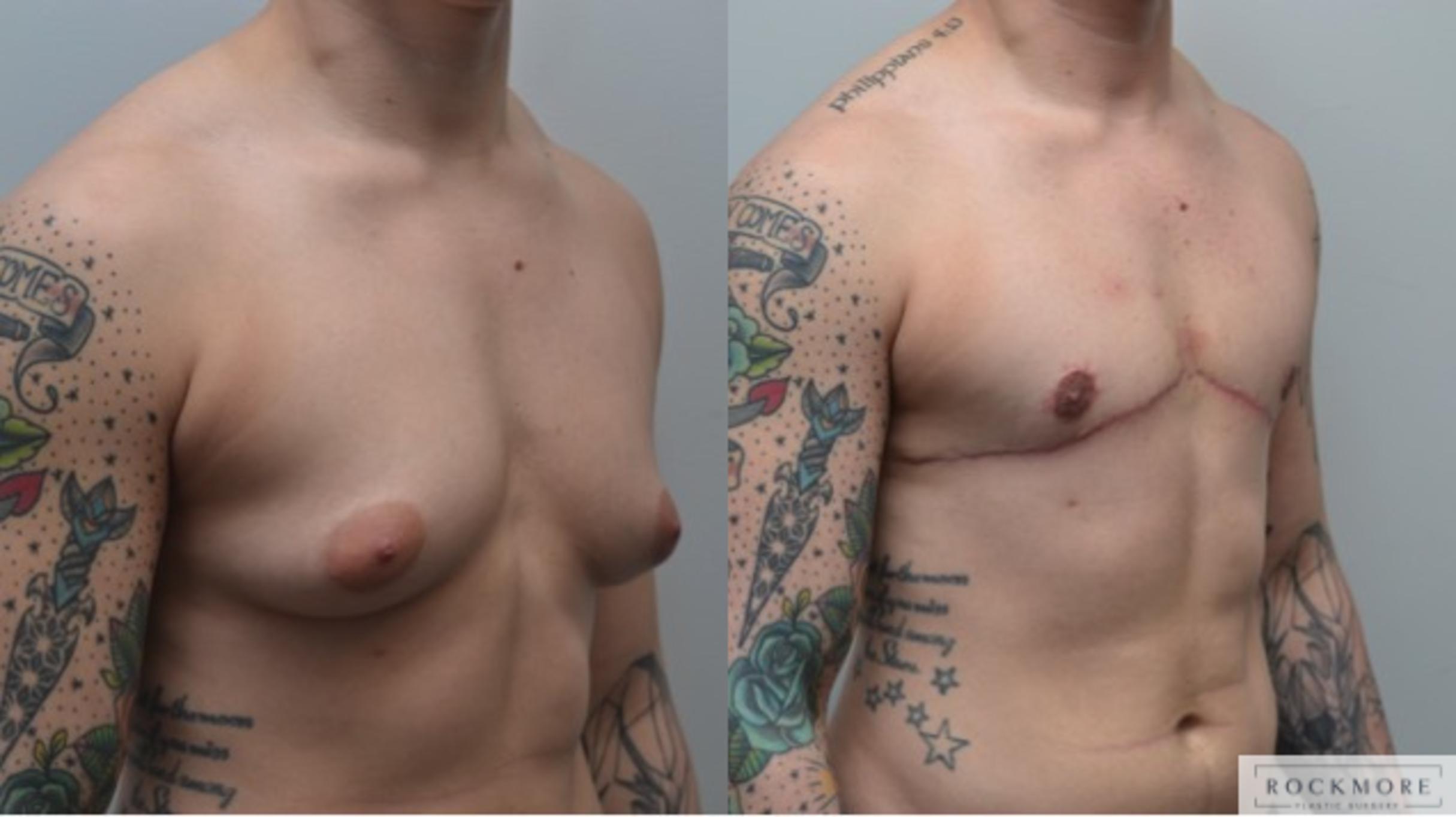 Before & After Gender Transformation FTM Case 286 View #4 View in Albany & Latham, New York