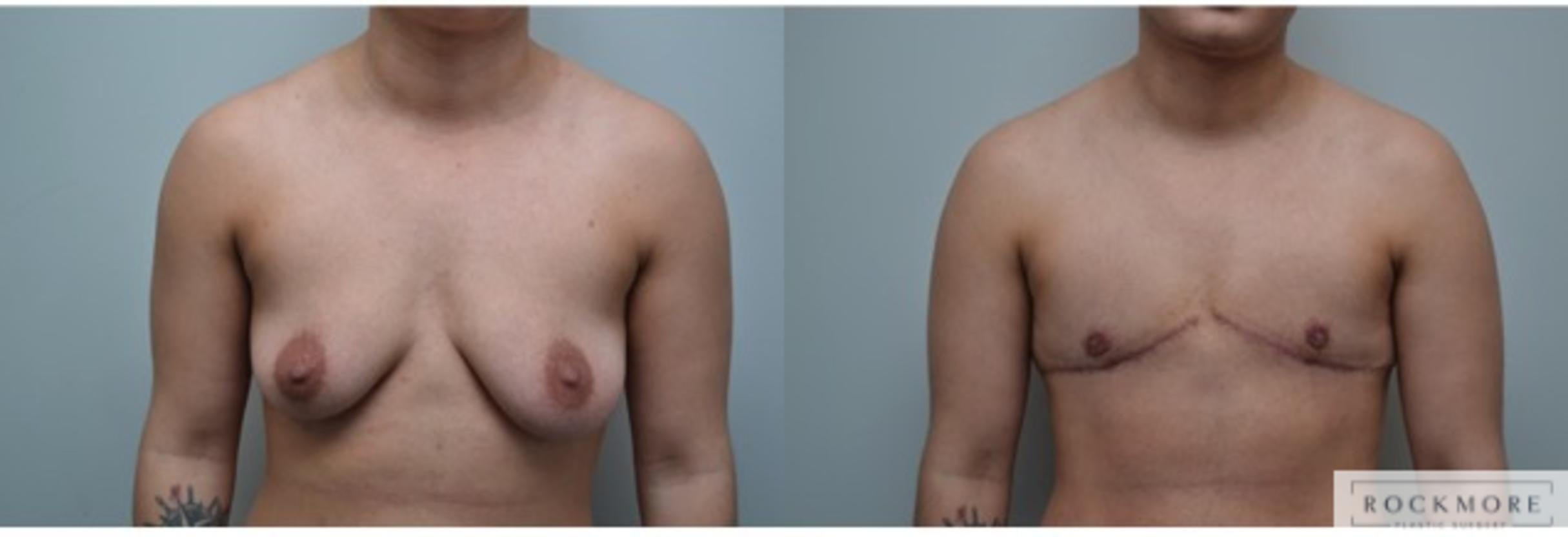 Before & After Gender Transformation FTM Case 290 View #1 View in Albany & Latham, New York