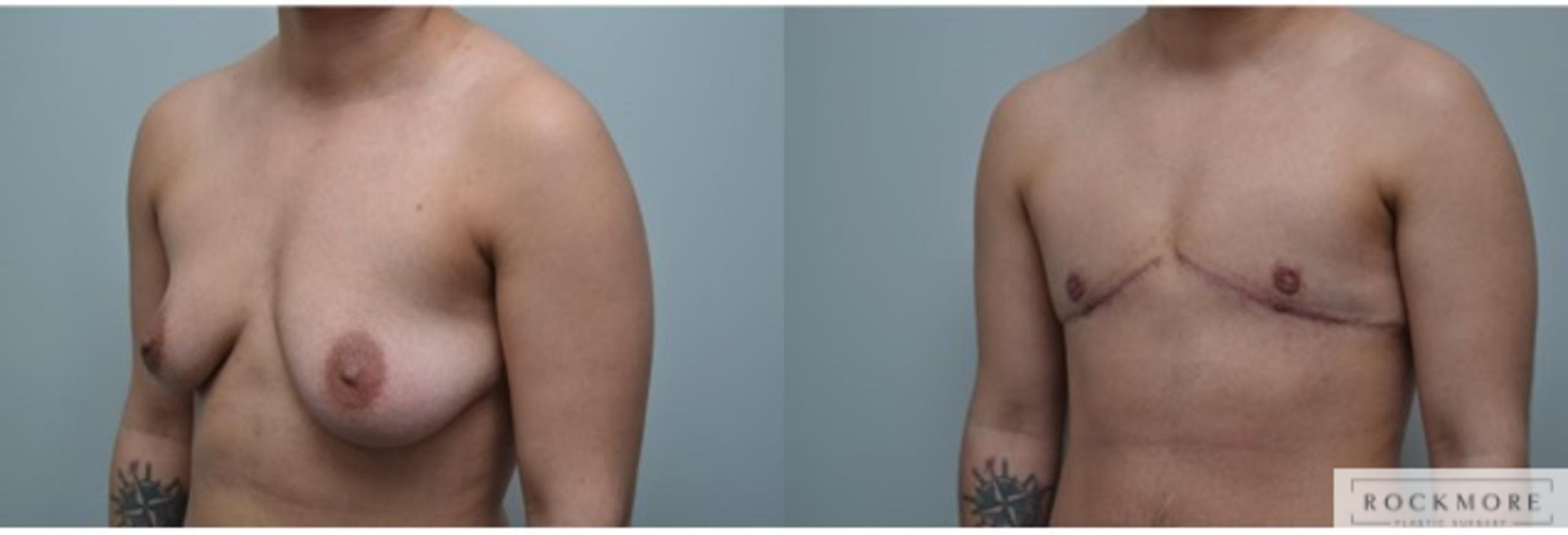 Before & After Gender Transformation FTM Case 290 View #2 View in Albany & Latham, New York