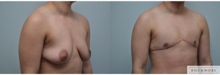 Before & After Gender Transformation FTM Case 290 View #5 View in Albany & Latham, New York