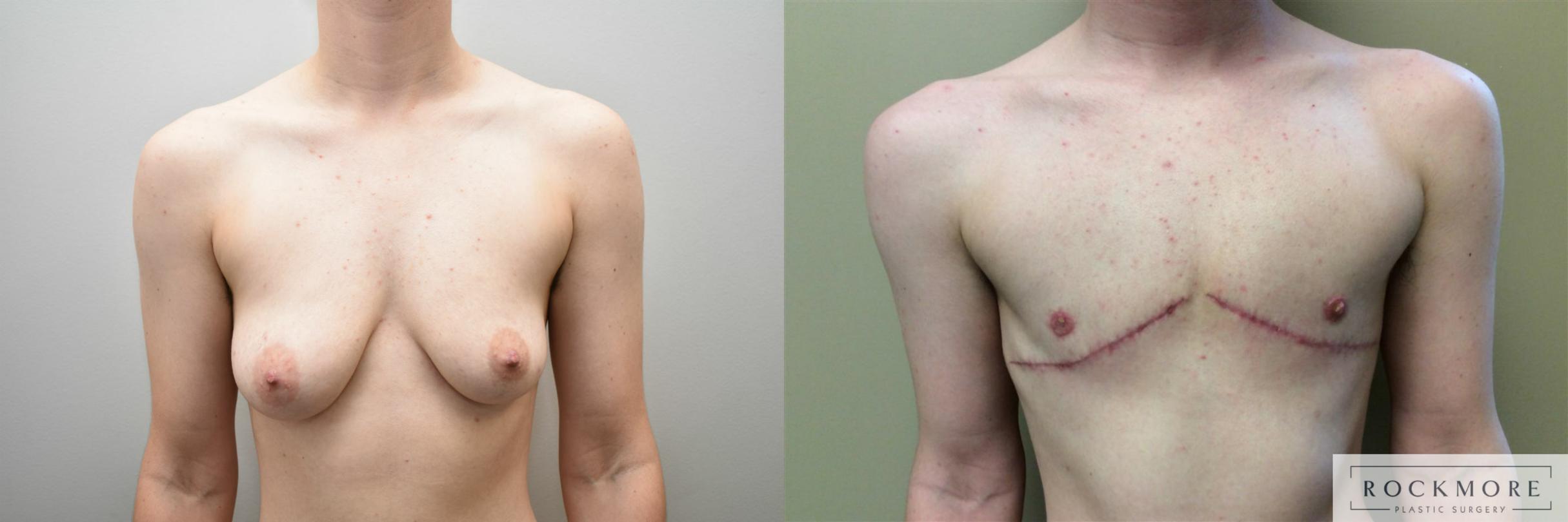 Before & After Gender Transformation FTM Case 315 View #1 View in Albany & Latham, New York