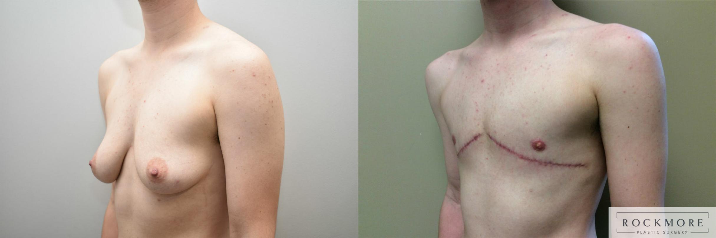 Before & After Gender Transformation FTM Case 315 View #2 View in Albany & Latham, New York