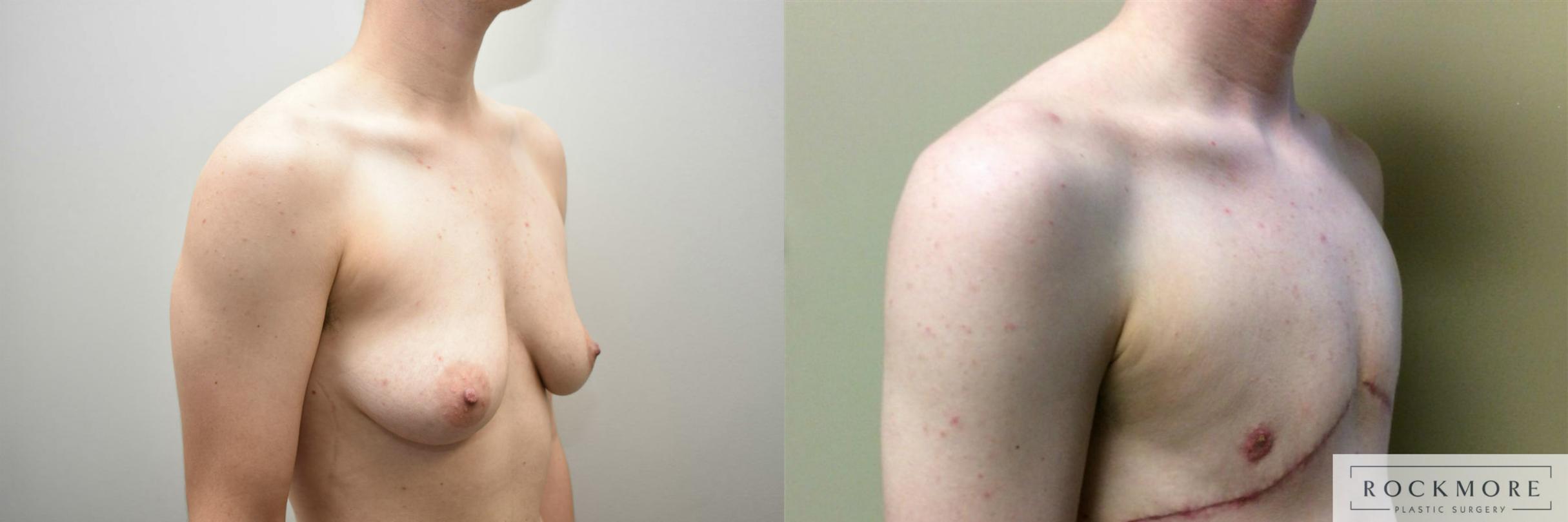 Before & After Gender Transformation FTM Case 315 View #4 View in Albany & Latham, New York