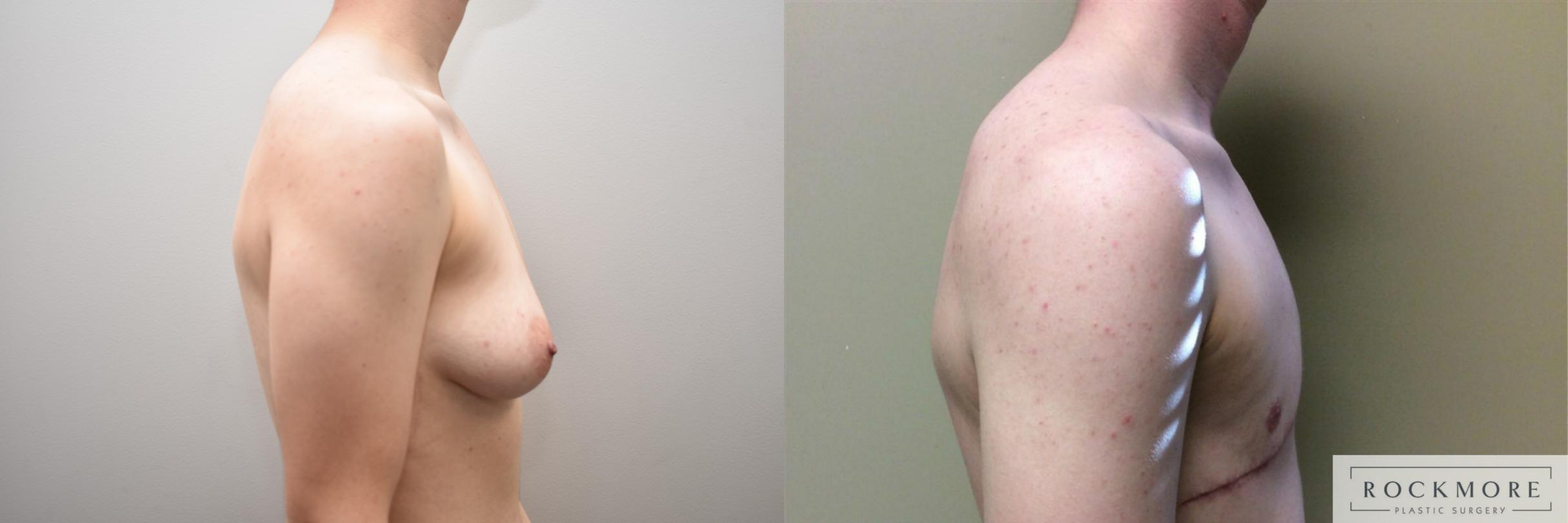 Before & After Gender Transformation FTM Case 315 View #5 View in Albany & Latham, New York