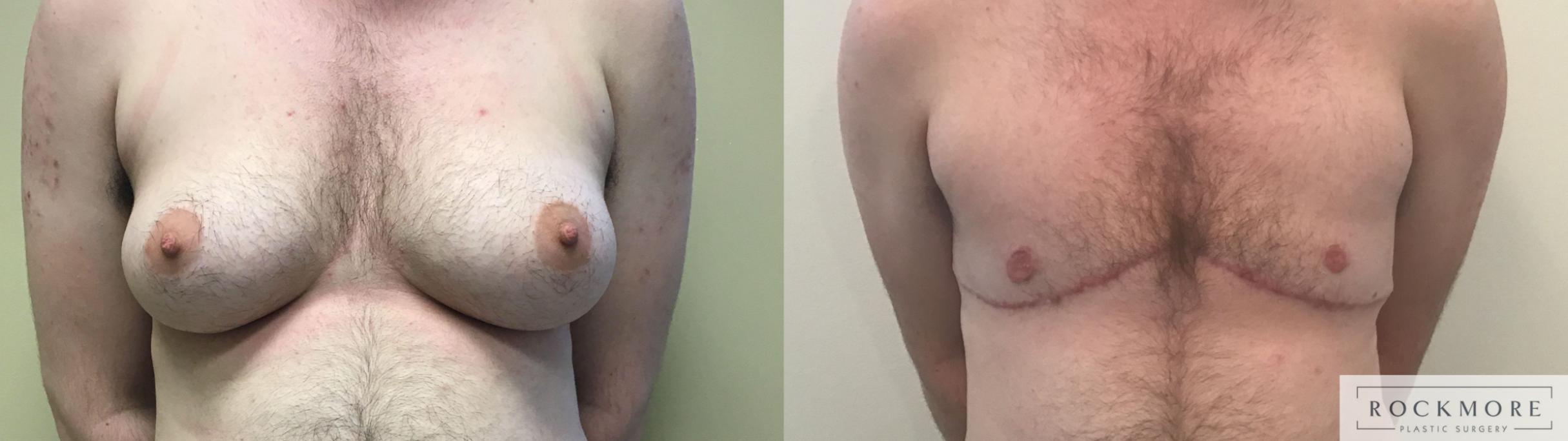 Before & After Gender Transformation FTM Case 392 Front View in Albany & Latham, New York