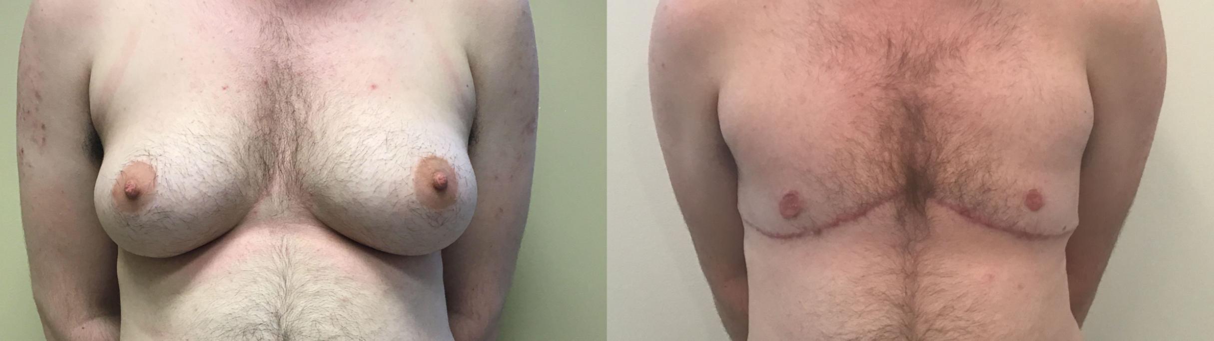 Before & After Gender Transformation FTM Case 392 Front View in Albany & Latham, New York