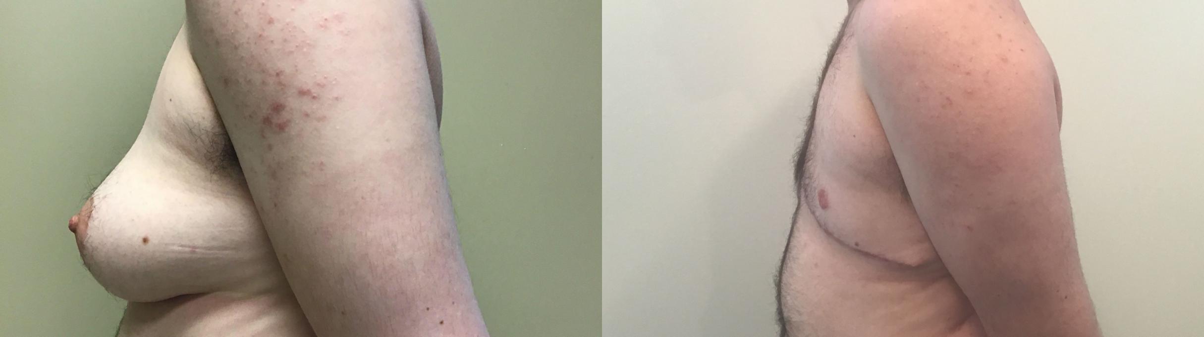 Before & After Gender Transformation FTM Case 392 Left Side View in Albany & Latham, New York