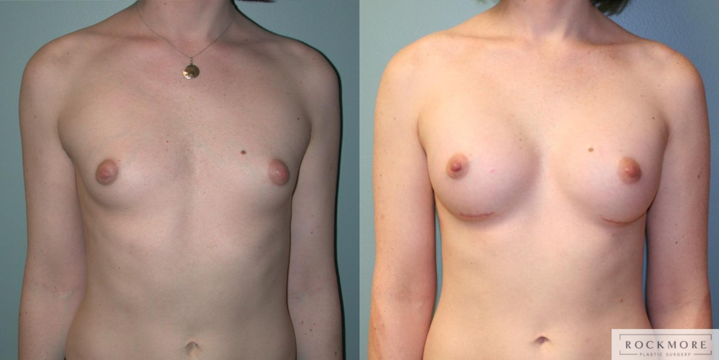 Before & After Gender Transformation MTF Case 177 View #1 View in Albany & Latham, New York