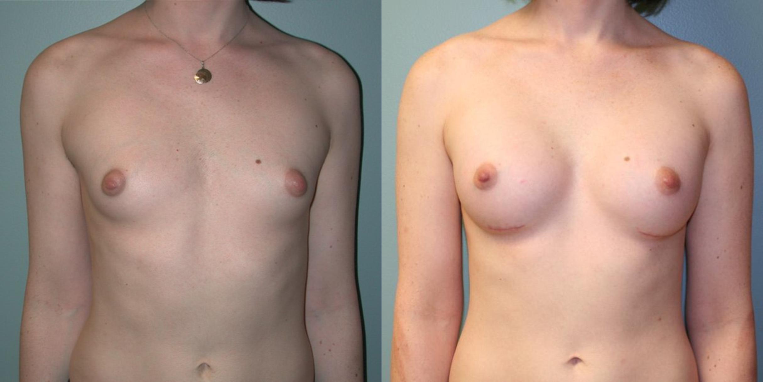 Before & After Gender Transformation MTF Case 177 View #1 View in Albany & Latham, New York