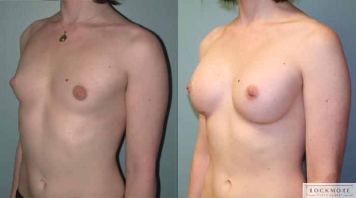 Before & After Gender Transformation MTF Case 177 View #2 View in Albany & Latham, New York