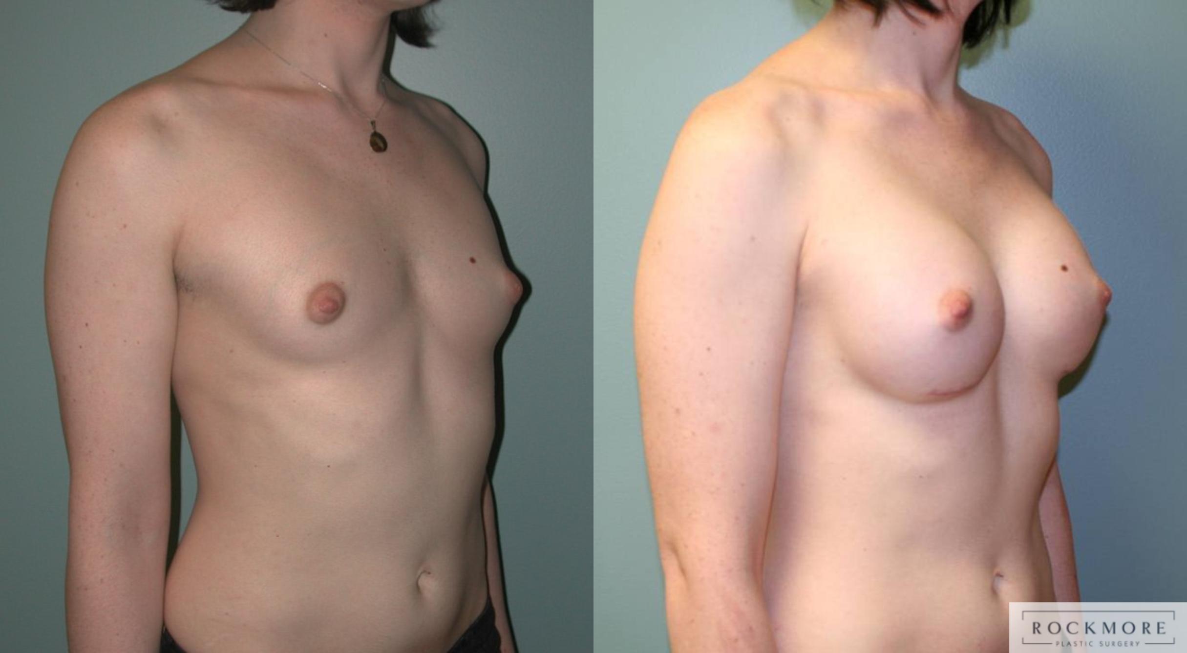 Before & After Gender Transformation MTF Case 177 View #3 View in Albany & Latham, New York
